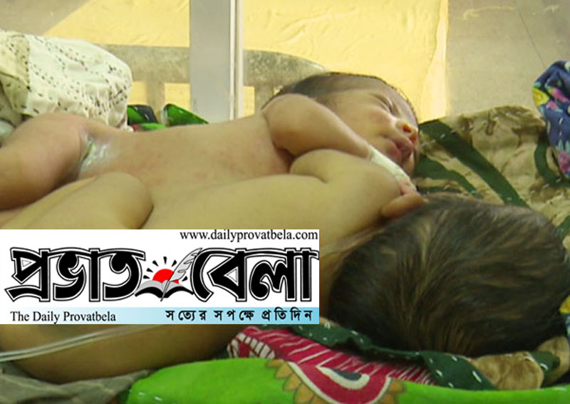 সিলেটের দুই শিশু ঢাকার হাসপাতালে