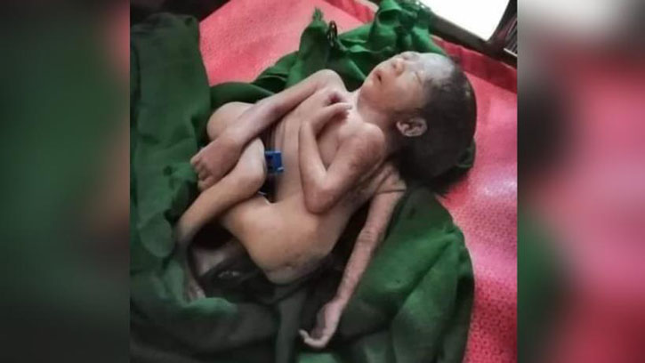 মহেশখালীতে ৪ পা ও ৩ হাত বিশিষ্ট শিশুর জম্ম
